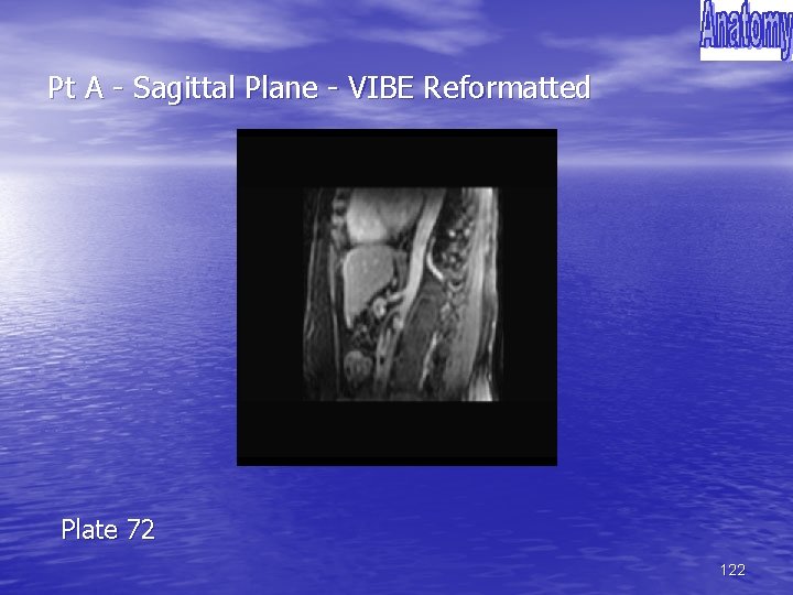 Pt A - Sagittal Plane - VIBE Reformatted Plate 72 122 