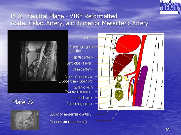 Pt A - Sagittal Plane - VIBE Reformatted Aorta, Celiac Artery, and Superior Mesenteric