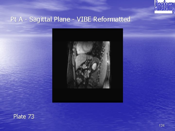 Pt A - Sagittal Plane - VIBE Reformatted Plate 73 124 