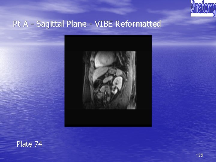 Pt A - Sagittal Plane - VIBE Reformatted Plate 74 125 