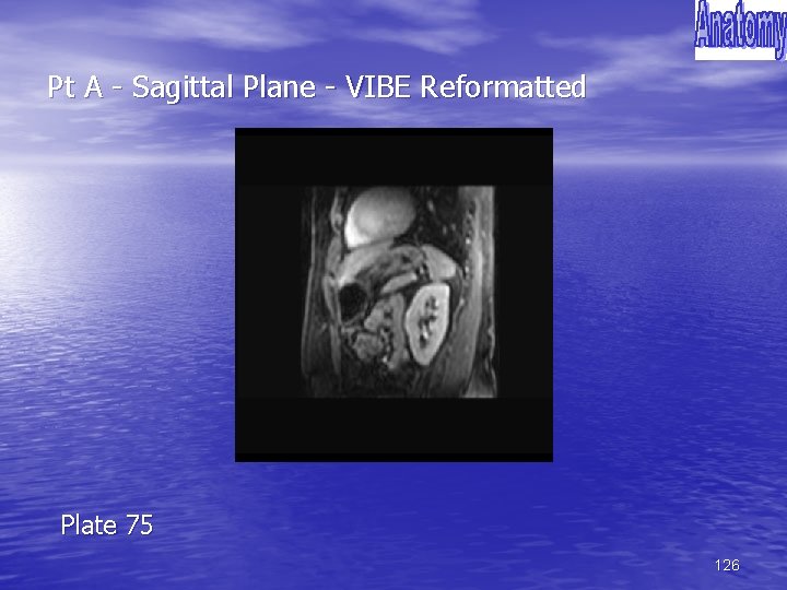 Pt A - Sagittal Plane - VIBE Reformatted Plate 75 126 