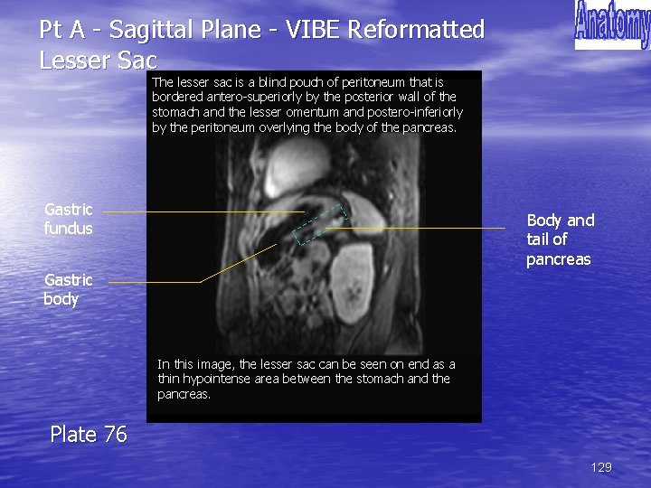Pt A - Sagittal Plane - VIBE Reformatted Lesser Sac The lesser sac is