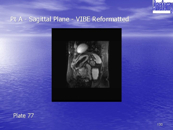 Pt A - Sagittal Plane - VIBE Reformatted Plate 77 130 