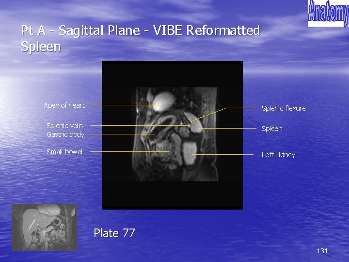 Pt A - Sagittal Plane - VIBE Reformatted Spleen Apex of heart Splenic flexure