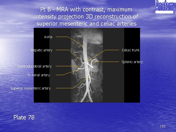 Pt B - MRA with contrast, maximum intensity projection 3 D reconstruction of superior