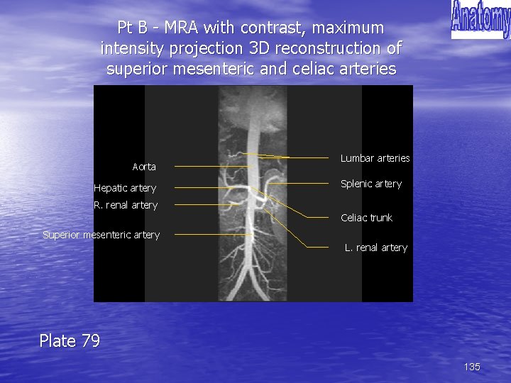 Pt B - MRA with contrast, maximum intensity projection 3 D reconstruction of superior