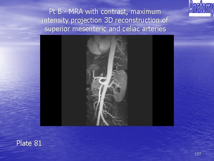 Pt B - MRA with contrast, maximum intensity projection 3 D reconstruction of superior