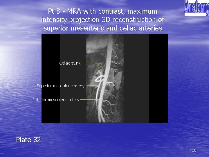 Pt B - MRA with contrast, maximum intensity projection 3 D reconstruction of superior