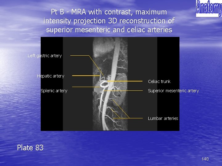 Pt B - MRA with contrast, maximum intensity projection 3 D reconstruction of superior