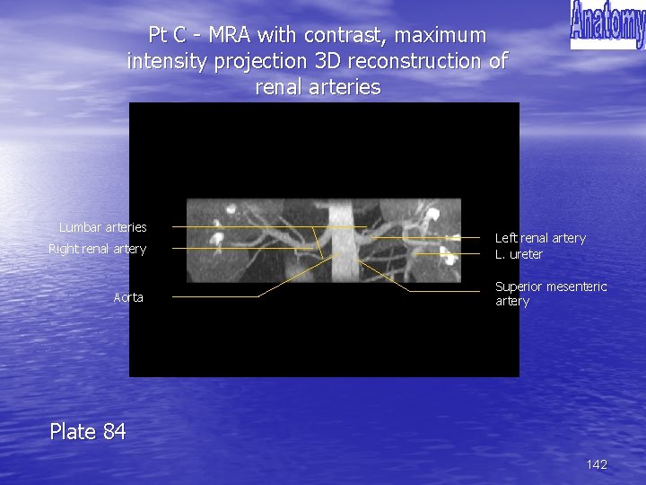 Pt C - MRA with contrast, maximum intensity projection 3 D reconstruction of renal