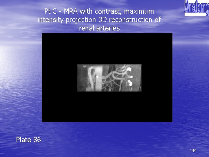 Pt C - MRA with contrast, maximum intensity projection 3 D reconstruction of renal