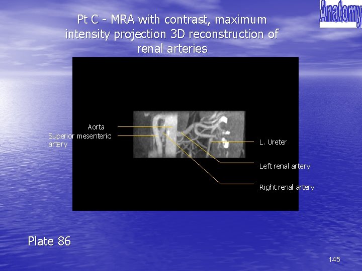 Pt C - MRA with contrast, maximum intensity projection 3 D reconstruction of renal