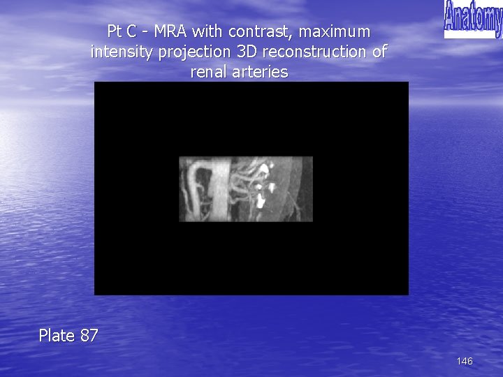 Pt C - MRA with contrast, maximum intensity projection 3 D reconstruction of renal