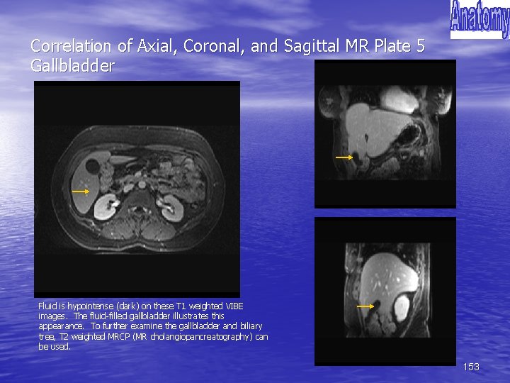 Correlation of Axial, Coronal, and Sagittal MR Plate 5 Gallbladder Fluid is hypointense (dark)