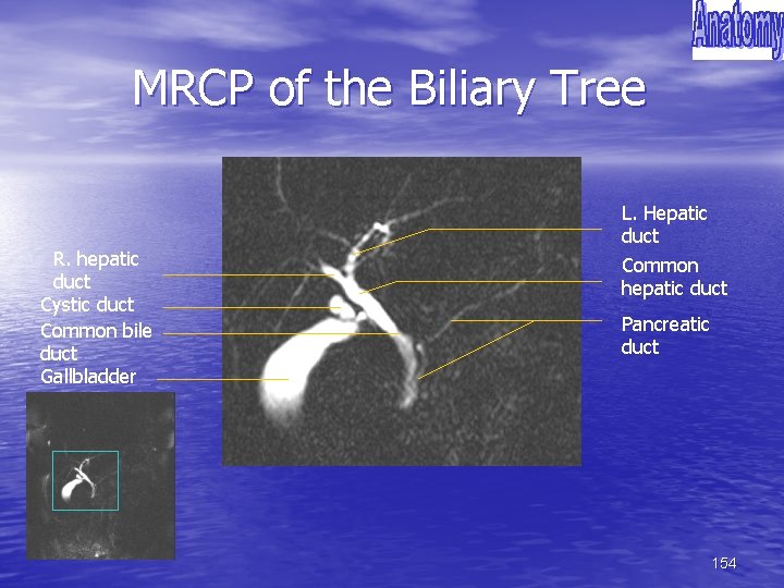 MRCP of the Biliary Tree R. hepatic duct Cystic duct Common bile duct Gallbladder