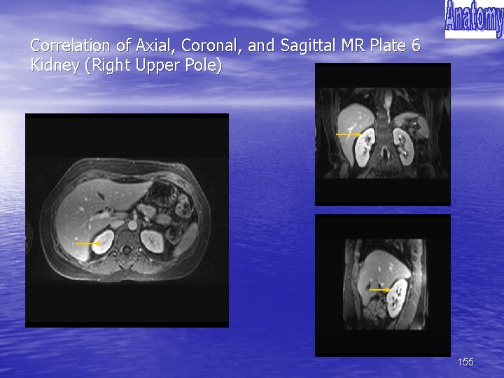 Correlation of Axial, Coronal, and Sagittal MR Plate 6 Kidney (Right Upper Pole) 155