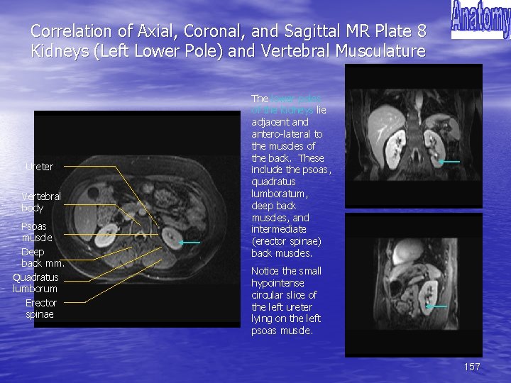 Correlation of Axial, Coronal, and Sagittal MR Plate 8 Kidneys (Left Lower Pole) and