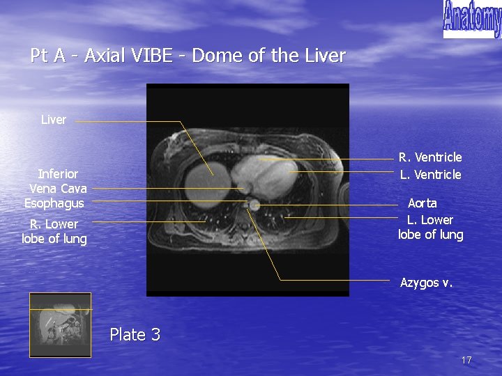 Pt A - Axial VIBE - Dome of the Liver R. Ventricle L. Ventricle