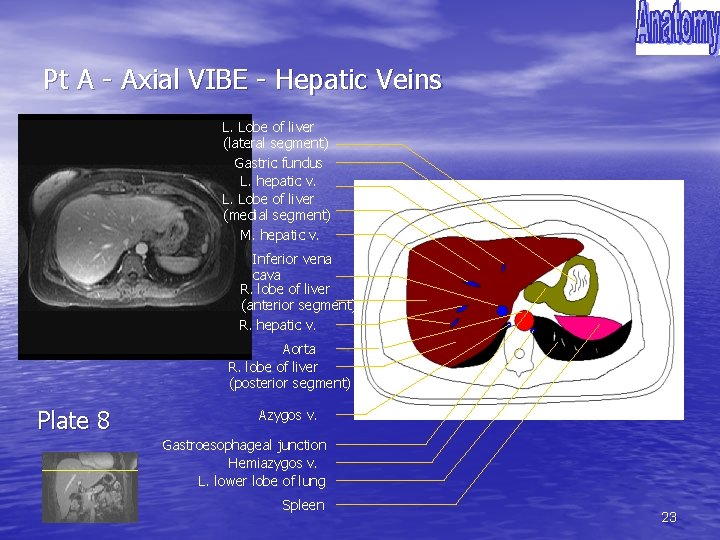 Pt A - Axial VIBE - Hepatic Veins L. Lobe of liver (lateral segment)