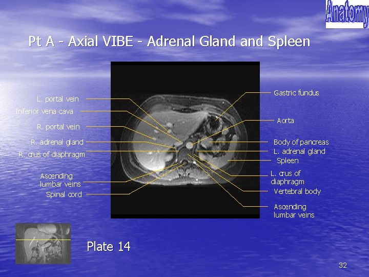 Pt A - Axial VIBE - Adrenal Gland Spleen Gastric fundus L. portal vein