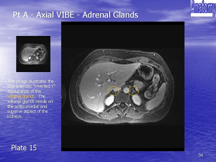 Pt A - Axial VIBE - Adrenal Glands This image illustrates the characteristic “inverted