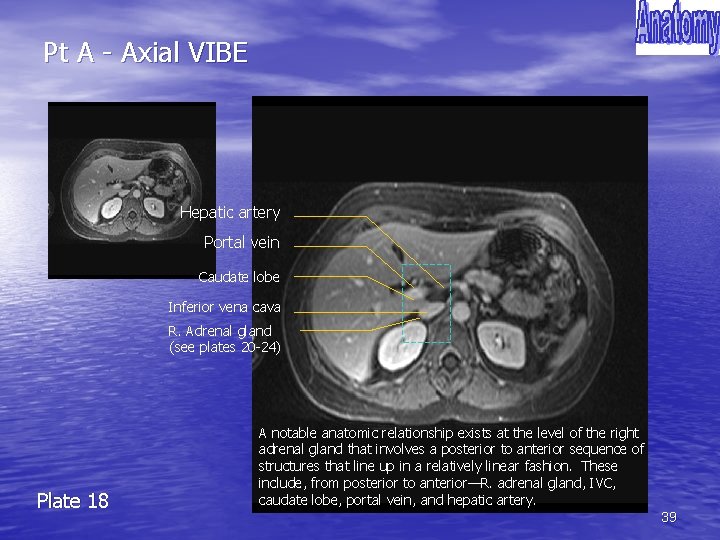 Pt A - Axial VIBE Hepatic artery Portal vein Caudate lobe Inferior vena cava