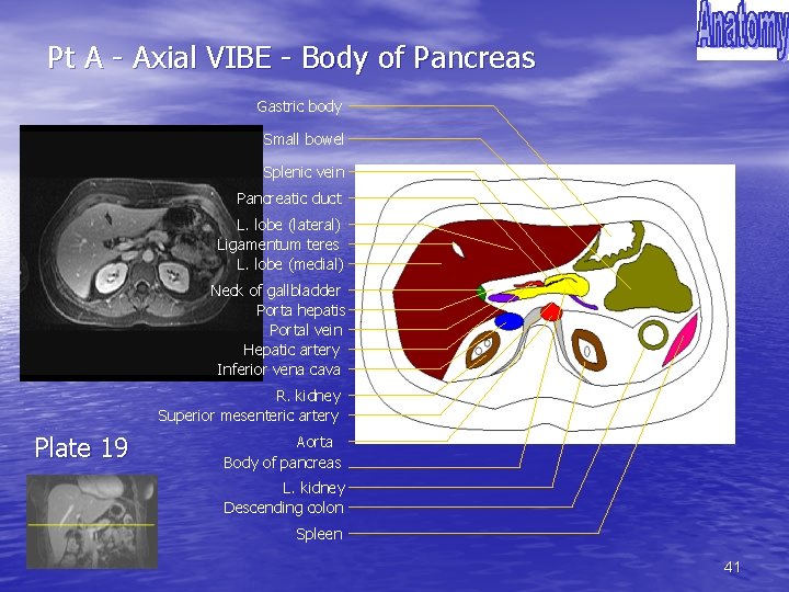 Pt A - Axial VIBE - Body of Pancreas Gastric body Small bowel Splenic