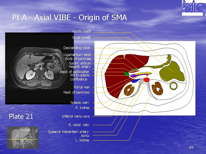 Pt A - Axial VIBE - Origin of SMA Gastric body Small bowel Descending