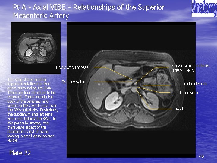 Pt A - Axial VIBE - Relationships of the Superior Mesenteric Artery Body of