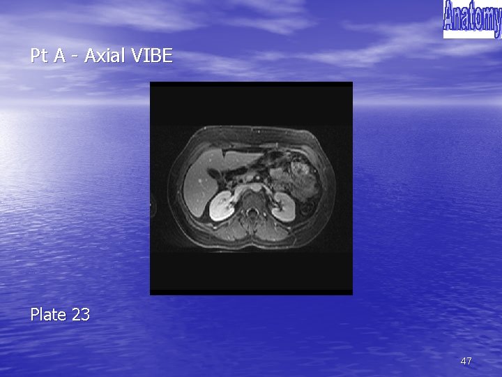 Pt A - Axial VIBE Plate 23 47 