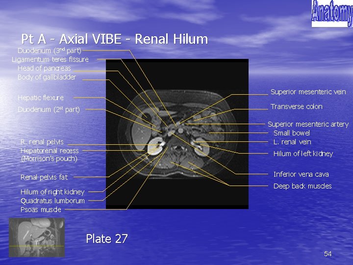 Pt A - Axial VIBE - Renal Hilum Duodenum (3 nd part) Ligamentum teres