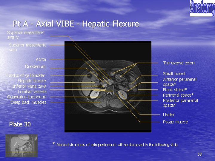 Pt A - Axial VIBE - Hepatic Flexure Superior mesenteric artery Superior mesenteric vein