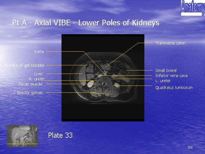 Pt A - Axial VIBE - Lower Poles of Kidneys Transverse colon Aorta Fundus