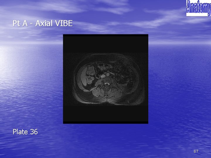 Pt A - Axial VIBE Plate 36 67 