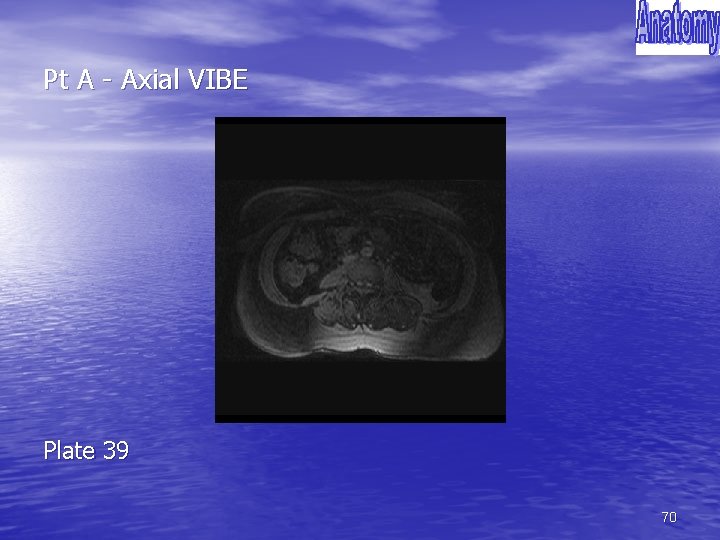 Pt A - Axial VIBE Plate 39 70 