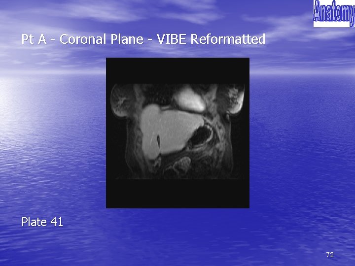 Pt A - Coronal Plane - VIBE Reformatted Plate 41 72 