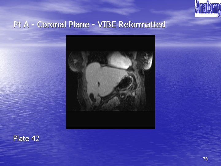 Pt A - Coronal Plane - VIBE Reformatted Plate 42 73 