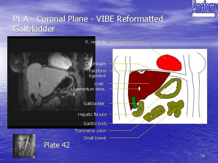 Pt A - Coronal Plane - VIBE Reformatted Gallbladder R. ventricle Diaphragm Falciform ligament