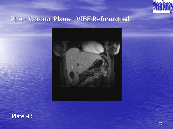 Pt A - Coronal Plane - VIBE Reformatted Plate 43 75 