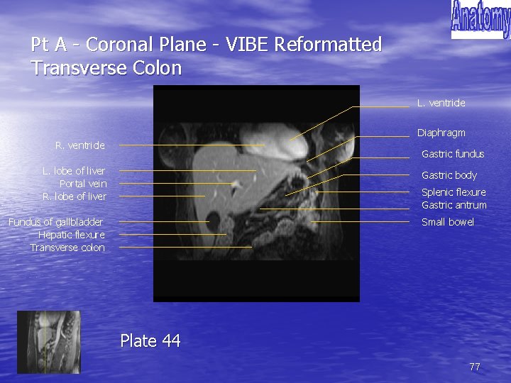 Pt A - Coronal Plane - VIBE Reformatted Transverse Colon L. ventricle Diaphragm R.