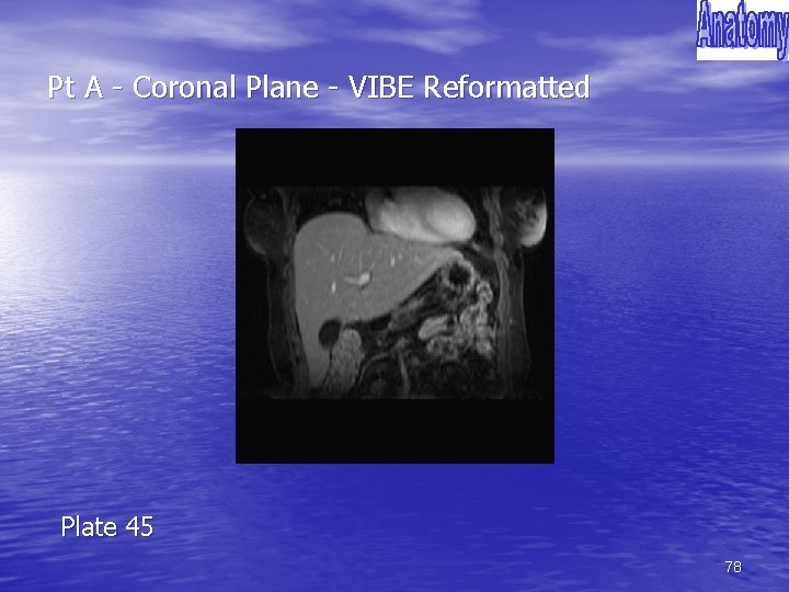 Pt A - Coronal Plane - VIBE Reformatted Plate 45 78 