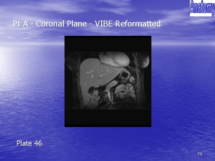 Pt A - Coronal Plane - VIBE Reformatted Plate 46 79 
