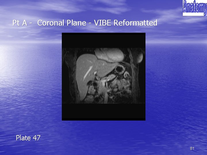 Pt A - Coronal Plane - VIBE Reformatted Plate 47 81 