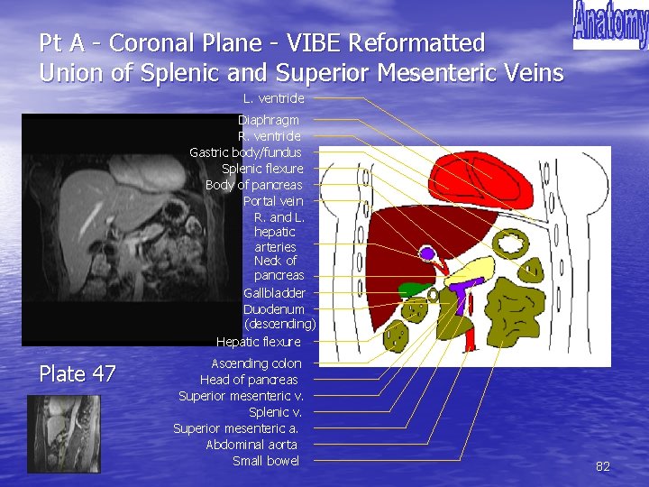 Pt A - Coronal Plane - VIBE Reformatted Union of Splenic and Superior Mesenteric