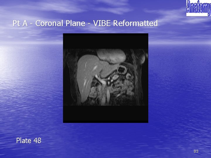 Pt A - Coronal Plane - VIBE Reformatted Plate 48 83 