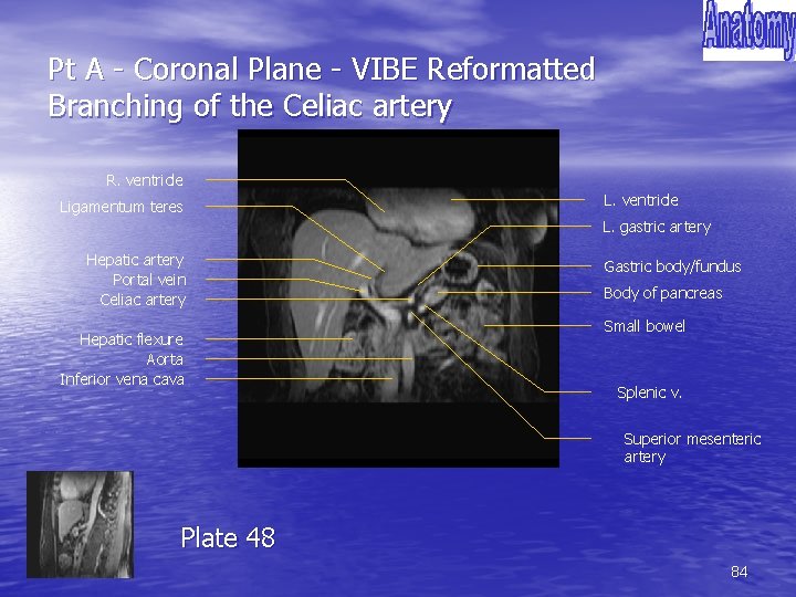 Pt A - Coronal Plane - VIBE Reformatted Branching of the Celiac artery R.