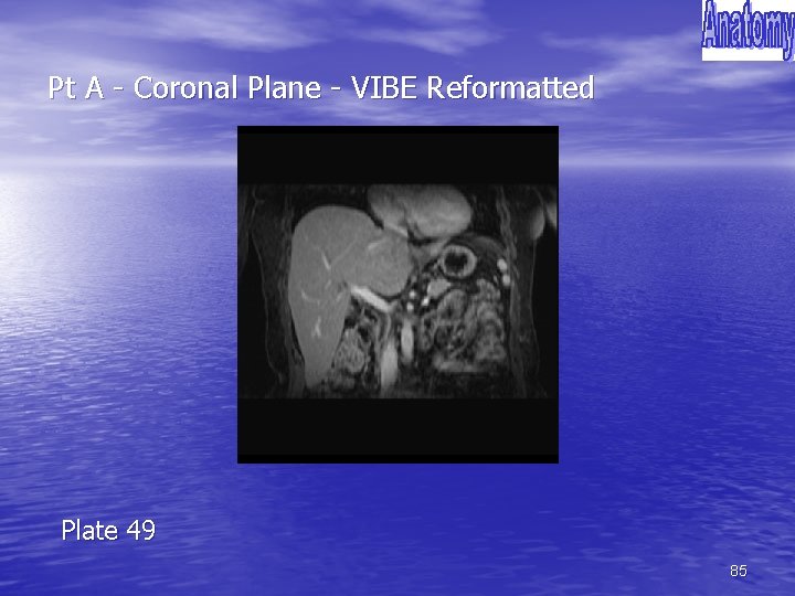 Pt A - Coronal Plane - VIBE Reformatted Plate 49 85 