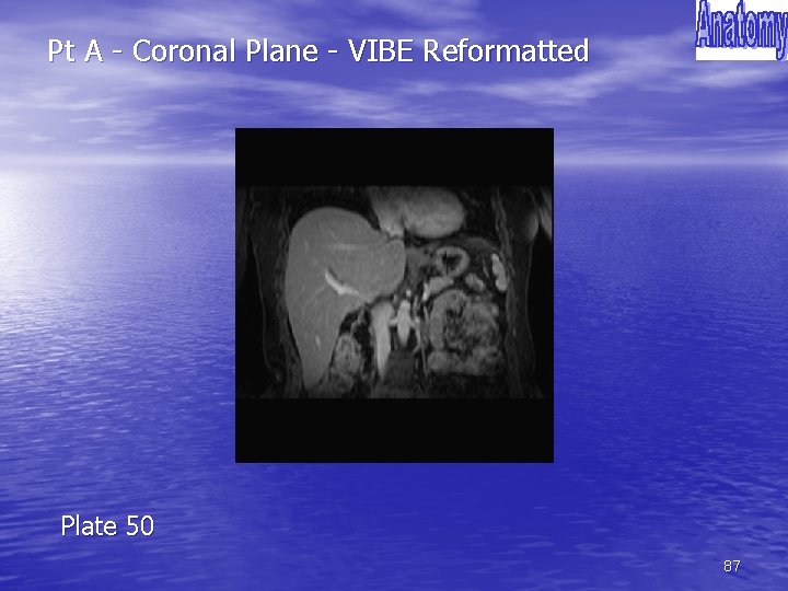 Pt A - Coronal Plane - VIBE Reformatted Plate 50 87 