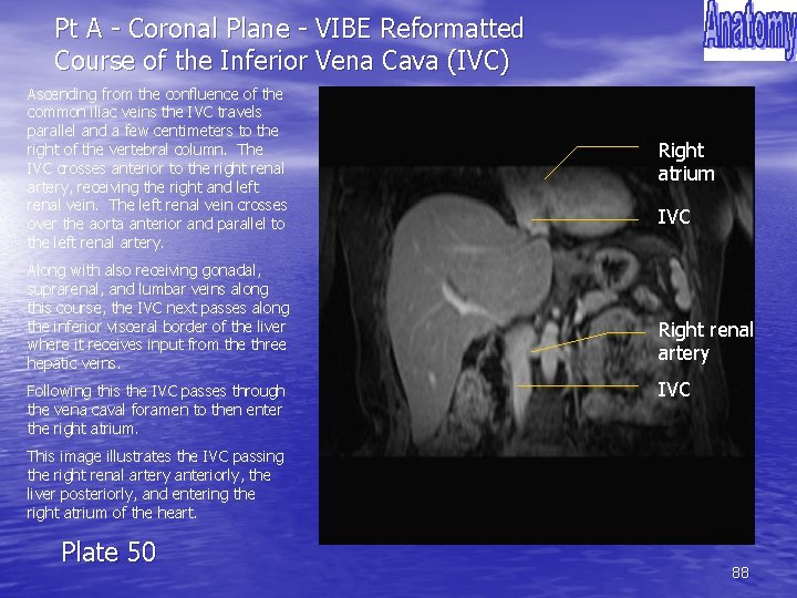 Pt A - Coronal Plane - VIBE Reformatted Course of the Inferior Vena Cava