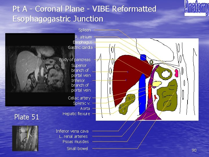 Pt A - Coronal Plane - VIBE Reformatted Esophagogastric Junction Spleen R. atrium Esophagus